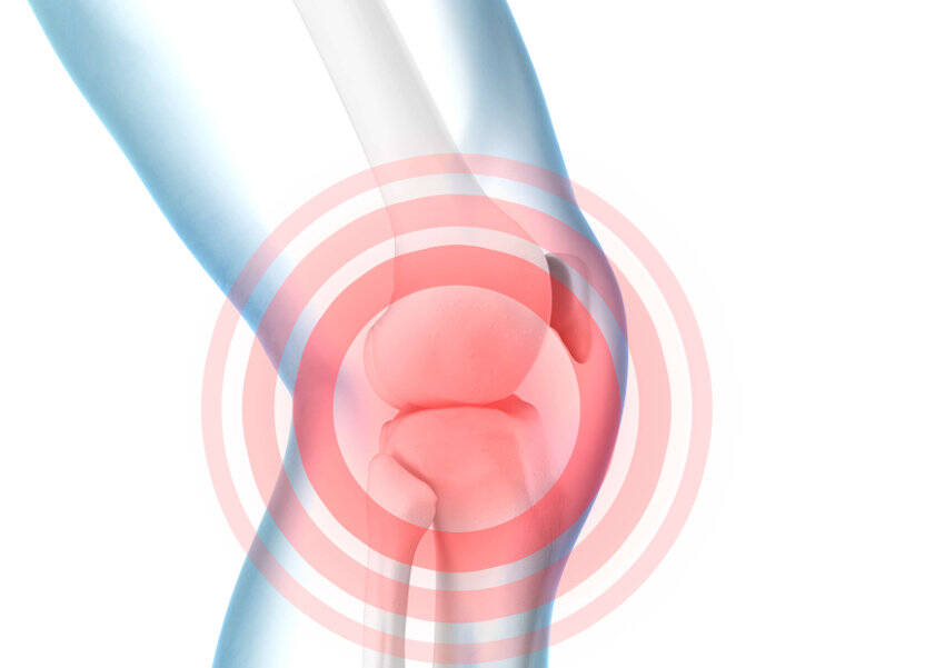 Schematische Darstellung von Knieschmerzen an einem Modell des Kniegelenks